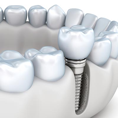 single dental implant placed in the lower arch